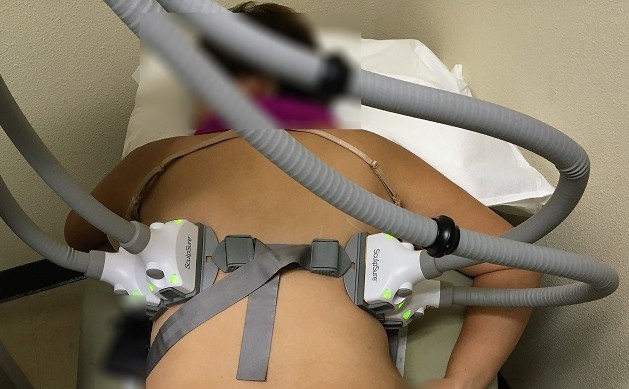 SculpSure treatment targeting unwanted back fat and bra bulge