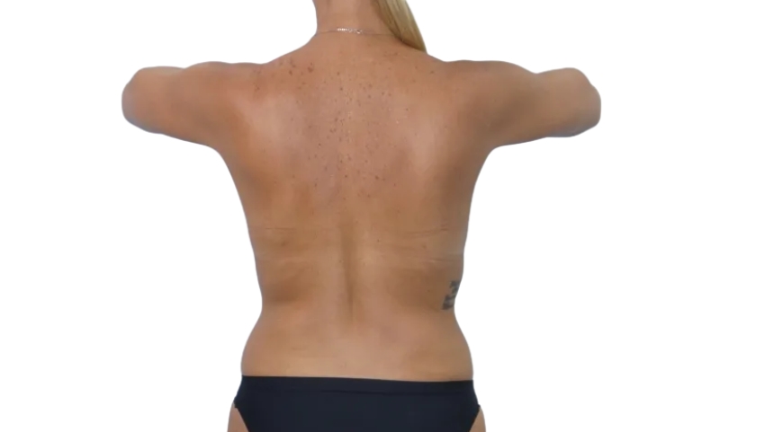 Toned abdomen after EMS Zero treatment