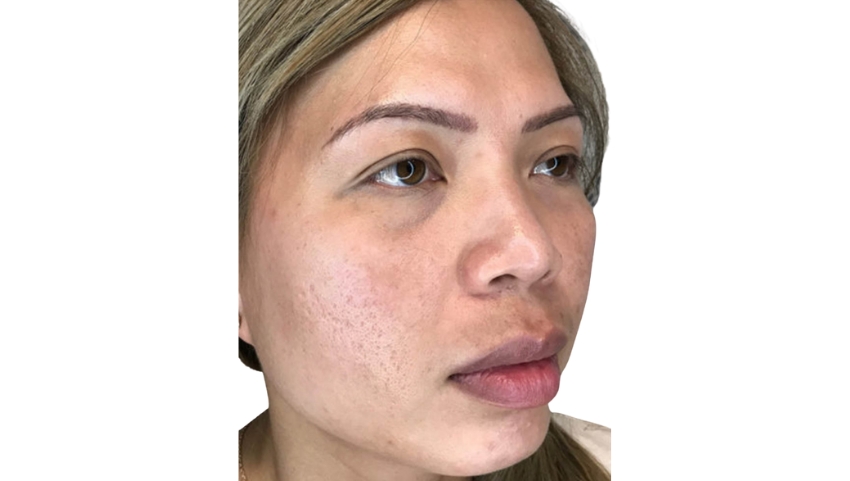 Face with skin imperfections before laser therapy
