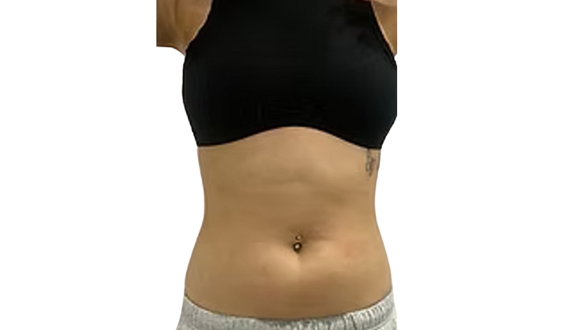 More defined chin and jawline after Lipo Injections