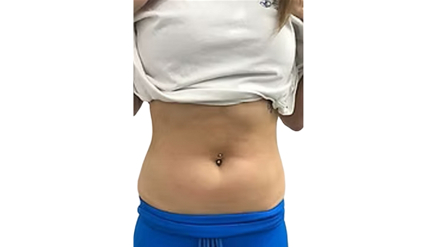 Chin and jawline area before Lipo Injections