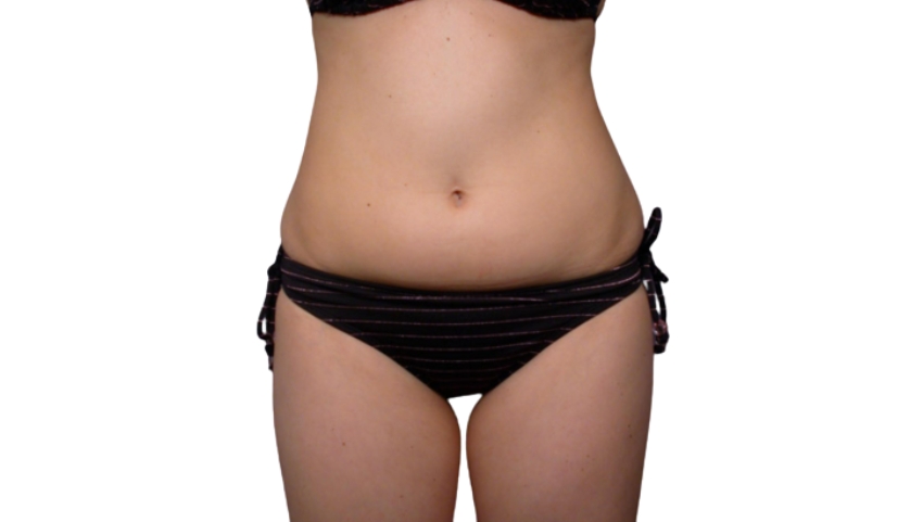 Body before SculpSure fat reduction treatment